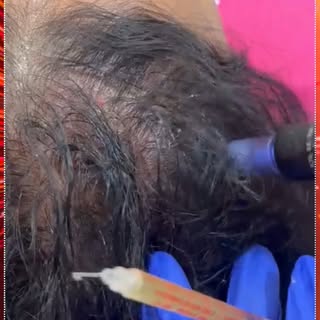 ✨ Hair Fall? Thinning Hair? It’s Time to Focus on Restoration.

Hair restoration treatments at Asthe
