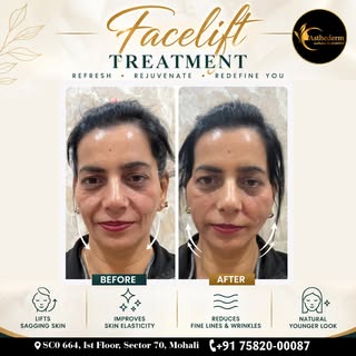 ✨ Face Lift Treatment | Refresh • Rejuvenate • Redefine

Want a more lifted and refreshed-looking ap
