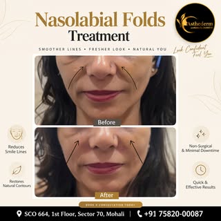 ✨ Nasolabial Folds Treatment | Smoother, Fresher-Looking You

Deep smile lines around the nose and m