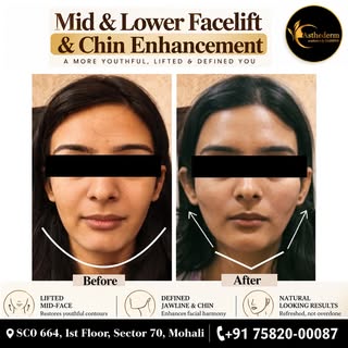 ✨ Mid & Lower Facelift + Chin Enhancement

Looking for a more lifted and defined facial appearance? 
