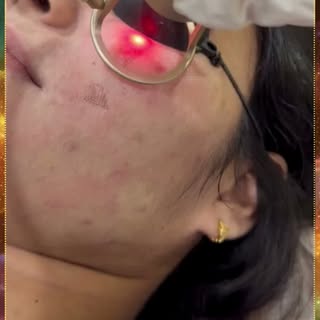 ✨ Chickenpox Scars Treatment
Chickenpox scars can leave uneven texture and visible marks on the skin