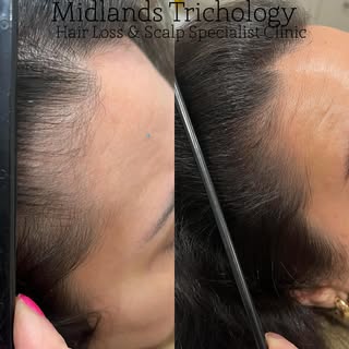 A fuller , stronger hairline following a combined treatment plan