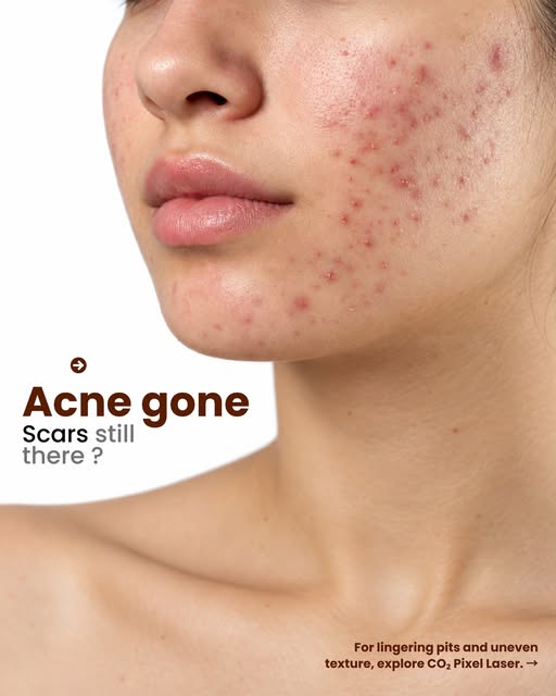 Acne chala gaya, par scars abhi bhi confidence ko hold kar rahe hain? 

CO₂ Pixel Laser skin ke natu