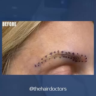 ✨ Another eyebrow transformation! ✨

We transplanted 300 grafts, and these results are already looki