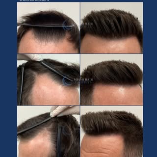 No Shave FUE results one year later with 2,310 follicular units transplanted. Incredible growth, nat