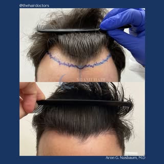 Manual FUE results looking incredible at the one year mark. A total of 2,003 follicular units were t