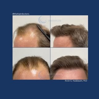 1 year later and the results are amazing! ✨ This patient received 2,641 follicular units with a Manu