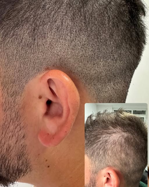 Na 4 sessies de zijkanten prachtig mooi opgevuld door Micro Hair Pigmentatie met een blijvend result