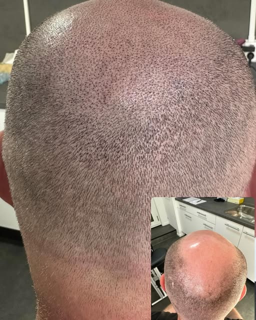 De specialist van het noorden 🤩 www.hairtattoovega.nl #kaalheidbijmannen #kaalheidbijvrouwen #alope