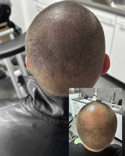 Een prachtig resultaat na 4 sessies van MHP met een blijvend resultaat voor jaren. WWW.HAIRTATTOOVEG