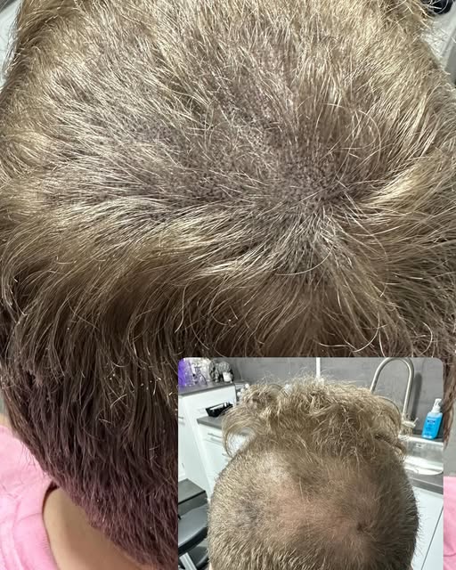 Een prachtig resultaat na 4 sessies van een optische Haarvolume behandeling door Micro Hair Pigmenta