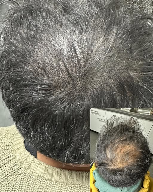 Een prachtig resultaat en een hele blije cliënt na 4 sessies van Micro Hair Pigmentatie met een blij