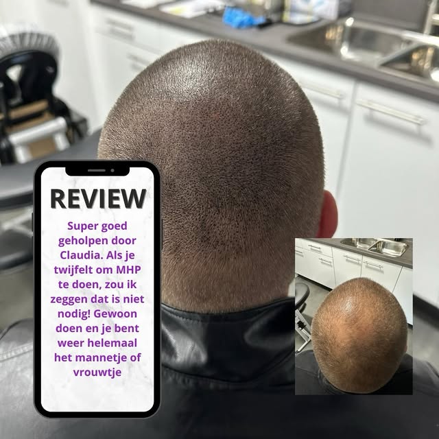 Een prachtig resultaat na 4 sessies van Micro Hair Pigmentatie (MHP) en een hele blije cliënt 💜 www