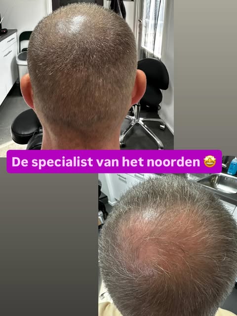 Micro Hair Pigmentatie (MHP) biedt de mooiste oplossingen voor mannen & vrouwen 🤩
www.hairtattooveg
