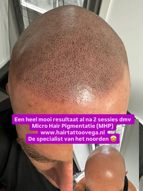 #haarverlies #haarverliesprobleem #haarproblemen #kaalheid #kaalheidbijmannen #kaalheidbijvrouwen #h