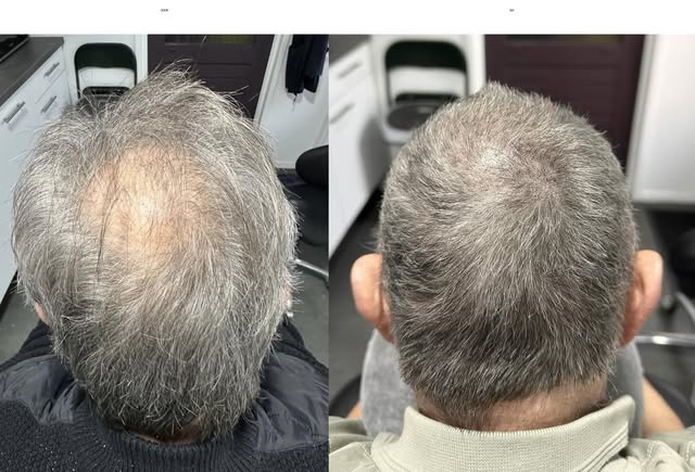 Weer een prachtig resultaat van Micro Hair Pigmentatie (MHP) na 4 sessies 🤩www.hairtattoovega.nl #h