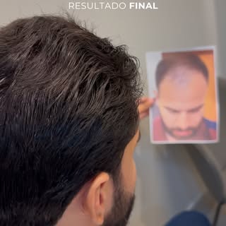 Chegamos ao resultado FINAL desse Transplante Capilar lindo de se ver... 

Nunca será apenas sobre c