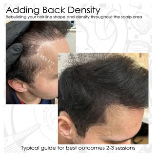 Boost your results from a hair transplant by adding further density through pigmentation can be the 