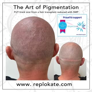 Hi Everyone, just wanted to share with you a clients journey with us treating an FUT scar track from