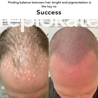 When a person’s hairline recedes, SMP can help reconstruct a natural-looking hairline. Skilled techn