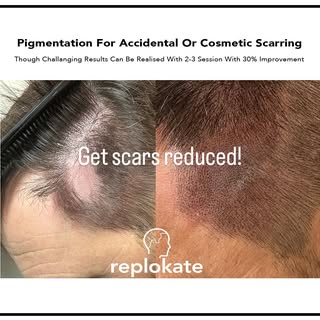If you have had scars from cosmetic procedures or accidental damage choosing Scalp micro pigmentatio