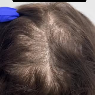 Why doesn’t restarting minoxidil work as well?

Because every time you stop, AGA keeps going.

The f