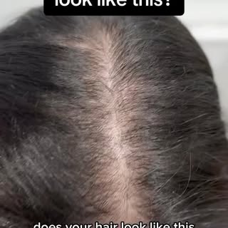 WHY ARE WOMEN LOSING THEIR HAIR?

The most common cause of progressive hair thinning in women is And