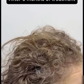 Advanced Androgenic Alopecia

Investigaiton: Blood tests, Trichoscopy and Biopsy 

Treatment:
Oral M