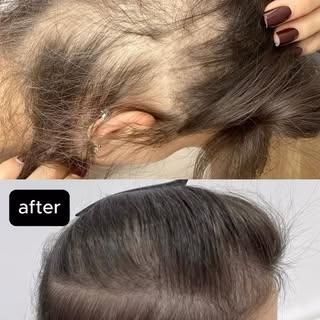 Advanced androgenetic alopecia (AGA) in young women: think beyond minoxidil. 🔬

Advanced hair loss 