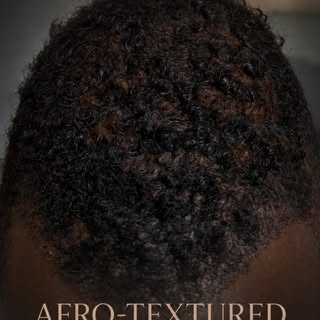 Afro-textured hair can have unique technical considerations during FUE hair transplant procedure (14