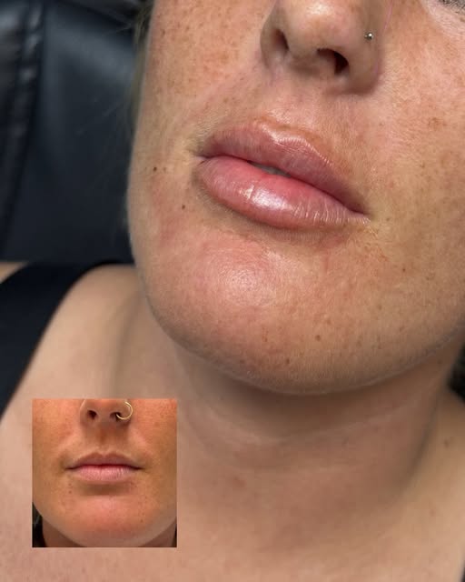 The goal isn’t bigger… it’s balanced. 🤍

Some of my favorite lip transformations lately. ✨

Every s
