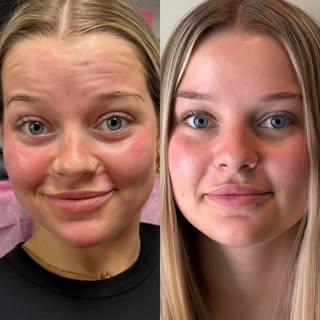 Baby Botox for a baddie 💉🤍

Think of it like folding a piece of paper. If you fold it over and ove