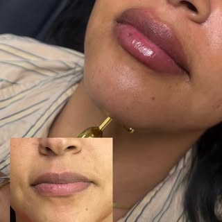 Slow and intentional always wins 💉

Built over 2 sessions using 1 mL total for a naturally fuller, 
