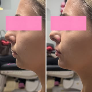 Side-profile maxxing 🫦

Strategic chin and lip filler were used to enhance facial harmony, improve 