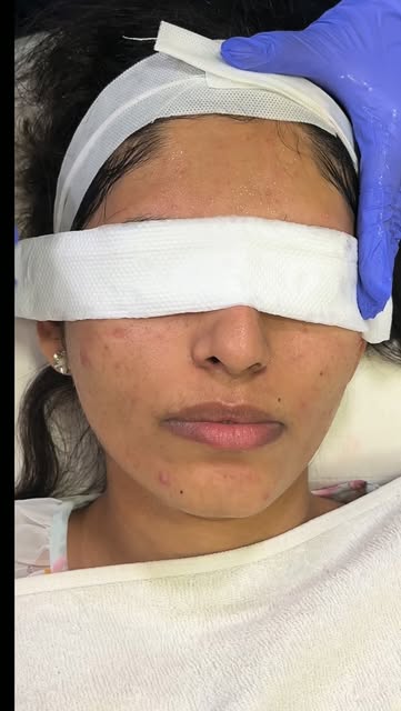 Chemical peel treatment 
#ᴄʜᴇᴍɪᴄᴀʟᴘᴇᴇʟ 
#alphahospital 
#skincare 
#glowingskin 
#dermatologist 
#pi