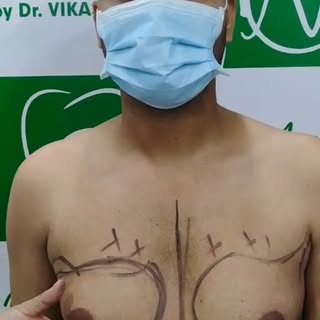 Grade 2 Gynecomastia Surgery Transformation 💪

Embarrassed by chest enlargement? You're not alone.
