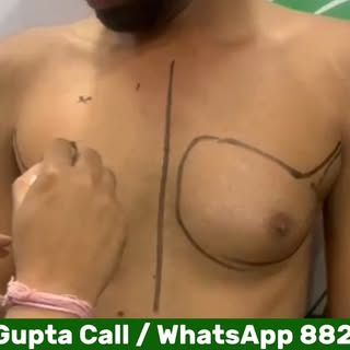 💪 Grade 2 Gynecomastia Surgery in Jaipur | On Table Result

देखिए Grade 2 Gynecomastia Surgery का श