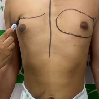 Grade 2 Gynecomastia Surgery ✅

Real patient. Real surgery. Real transformation. 💪

Achieve a flatt