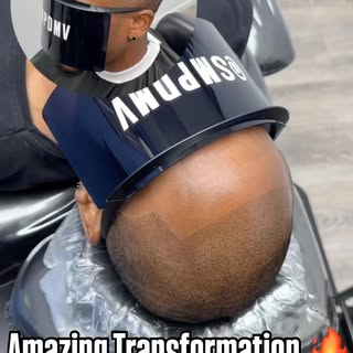 First Session ✅

Scalp Micro Pigmentation (SMP) is a permanent solution for hair loss of any kind; t