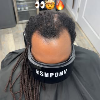 First Session ✅

Scalp Micro Pigmentation (SMP) is a permanent solution for hair loss of any kind; t