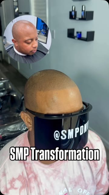 Scalp Micro Pigmentation (SMP) is a permanent solution for hair loss of any kind; thinning, bald spo