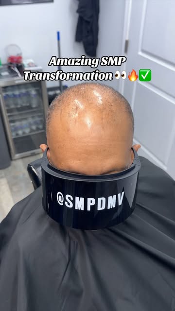 Session 1 of 3 ✅. Redness will subside 👍🏽. 

Scalp Micro Pigmentation (SMP) is a permanent solutio