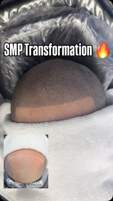 Scalp Micro Pigmentation (SMP) is a permanent solution for hair loss of any kind; thinning, bald spo