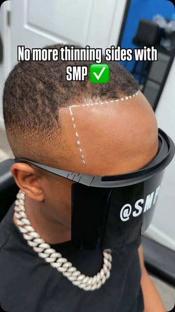 This client was tired of getting his line pushed back because of thinning hair on the sides. Now wit