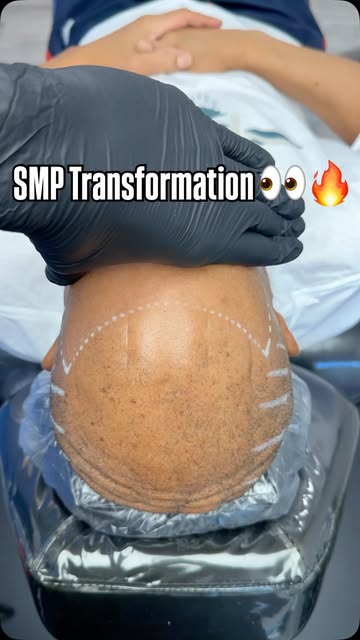 Scalp Micro Pigmentation (SMP) is a permanent solution for hair loss of any kind; thinning, bald spo