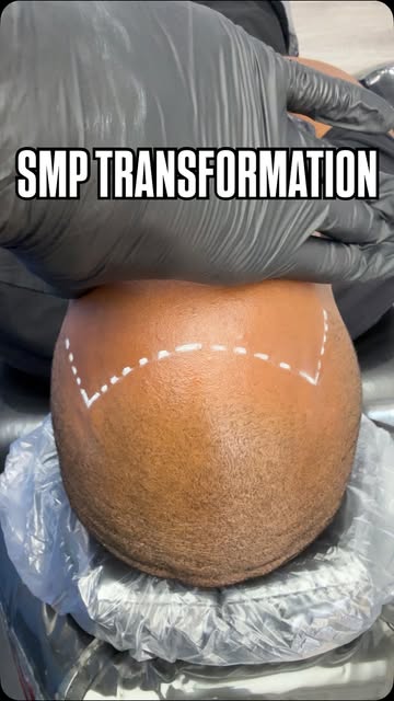 Scalp Micro Pigmentation (SMP) is a permanent solution for hair loss of any kind; thinning, bald spo