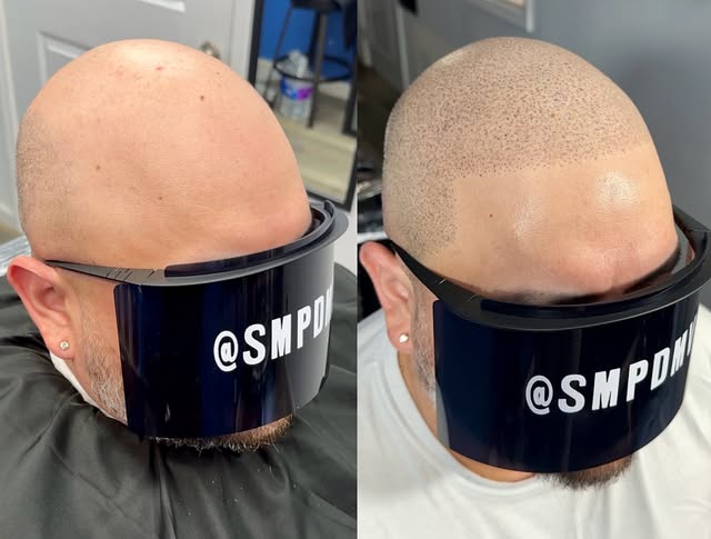 This client requested a slightly softer look for his procedure so of course we delivered! ✅ Redness 