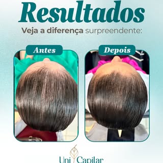 ✨ Resultados que refletem um tratamento baseado em ciência e constância.

Após 6 sessões com ativos 