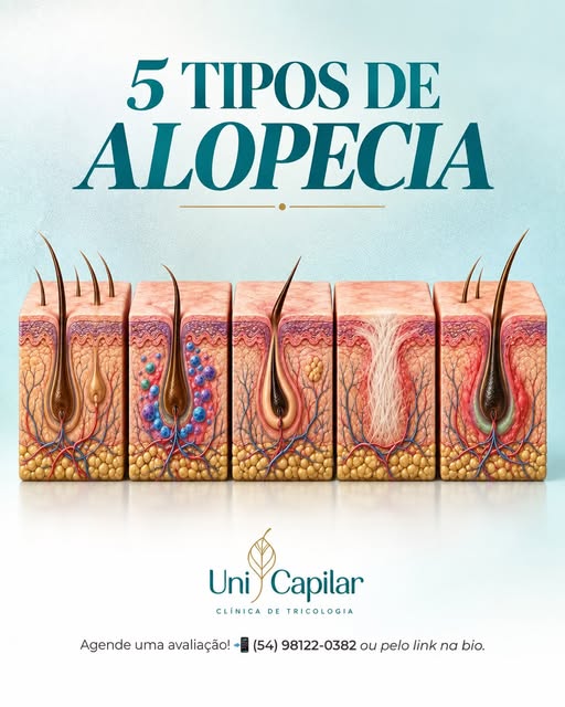 🧬 Nem toda alopecia é igual. E entender a diferença faz toda a diferença.

Você sabia que existem d