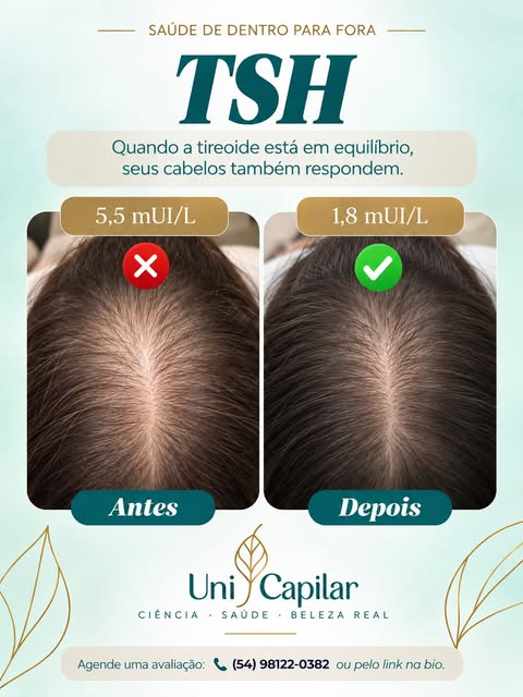 ✨ Cabelo saudável começa de dentro para fora!

Você sabia que alguns nutrientes e hormônios podem es